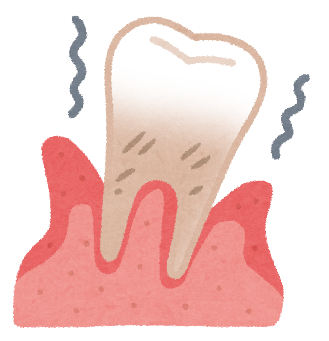 ジスロマックは歯周病にも効果がある！